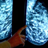 Breast Cancer Screenings are being missed in Birmingham