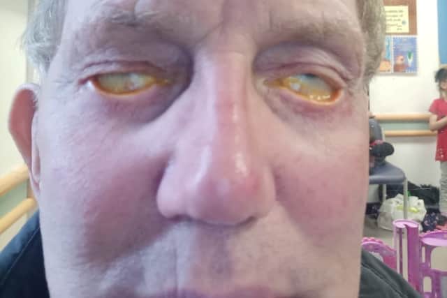 Pete Broadhurst, from Sutton Coldfield, after his cosmetic surgery which has left him unabe to close his eyes since 2019
