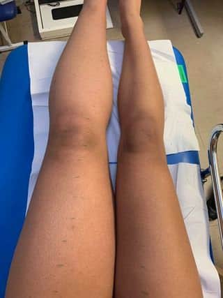 University of Birmingham student Didi Okoh, 19, was diagnosed with lymphedema 