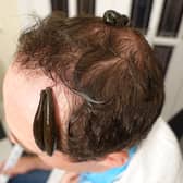 Birmingham leech therapy to treat baldness