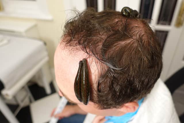 Birmingham leech therapy to treat baldness
