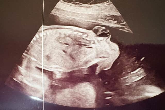 Laura Whitehouse's baby scan which led to the revelation that Samson had Spina Bifida myelomeningocele.