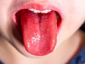 Tongue of a child with scarlet fever - strawberry tongue.