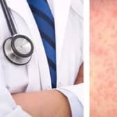 Measles is highly infectious and can lead to serious health complications.