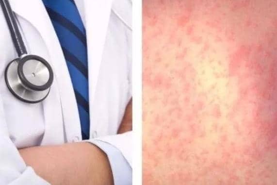 Measles is highly infectious and can lead to serious health complications.